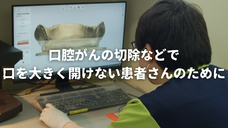 折りたたみ式入れ歯を開発し、開口障害がある方も顎義歯を使えるように 2枚目