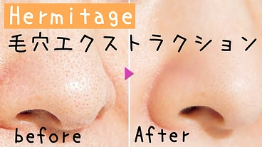 いちご鼻脱却！毛穴エクストラクションで、誰もが憧れるツルスベ肌へ。 のトップ画像