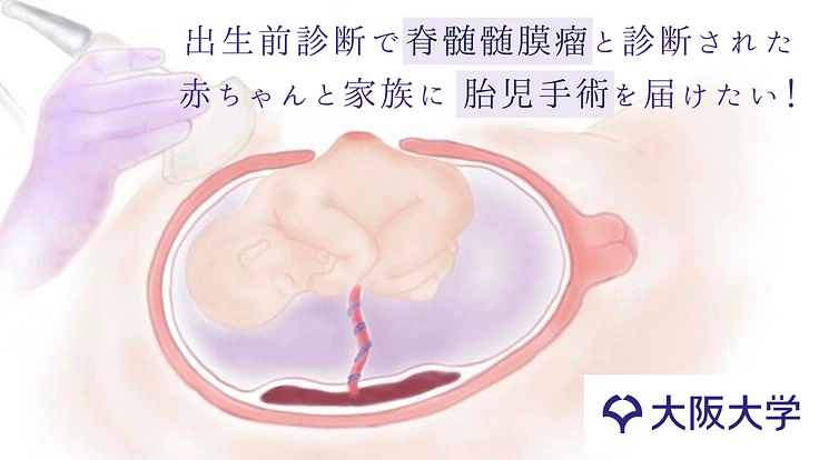 お母さんのおなかの中で難病の手術を。胎児手術が選択できる未来へ挑む