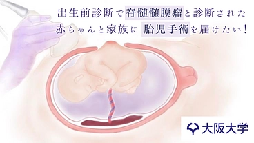 お母さんのおなかの中で難病の手術を。胎児手術が選択できる未来へ挑む のトップ画像