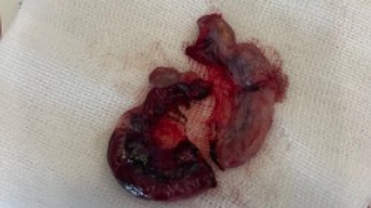 不妊手術しました。