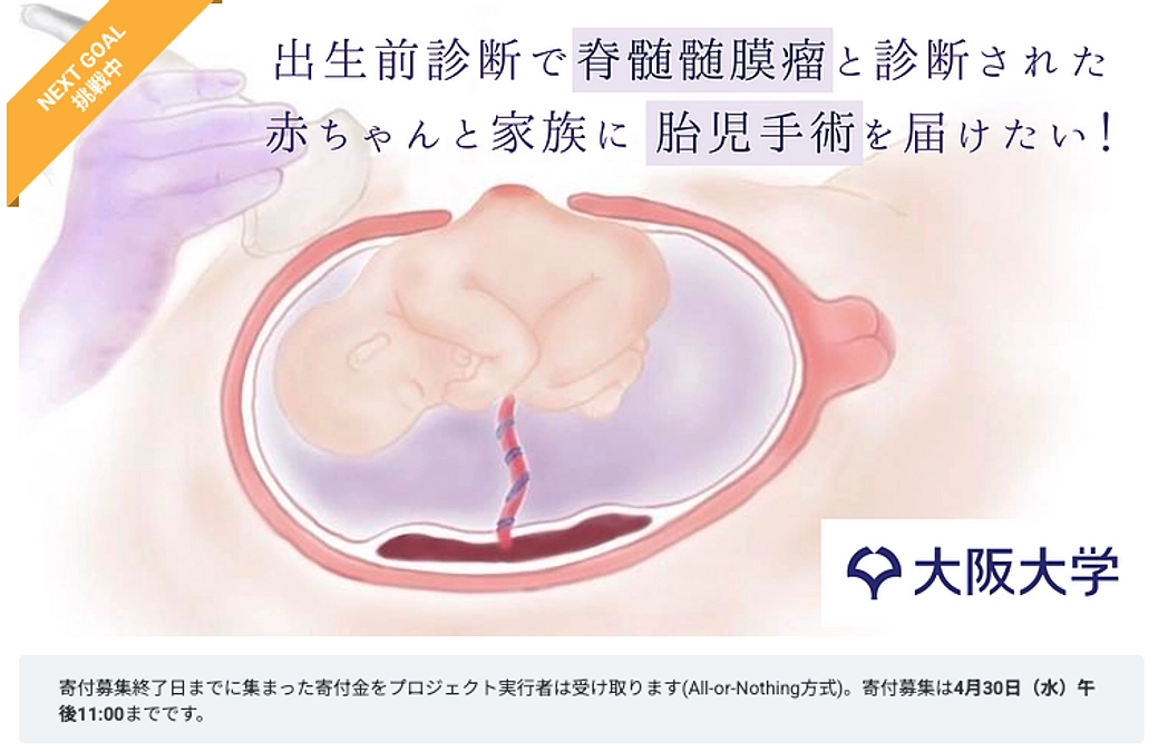 「お母さんのおなかの中で難病の手術を。胎児手術が選択できる未来へ挑む」についてのお知らせ（明日終了）