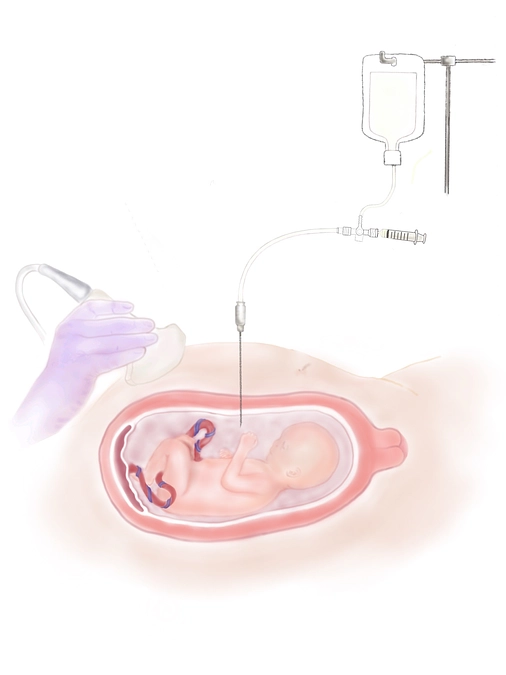 胎児手術にまつわるよもやまばなし⑦