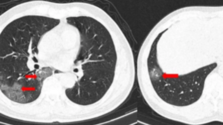 新型コロナウィルスによる肺炎を早期発見する為の低線量CT導入
