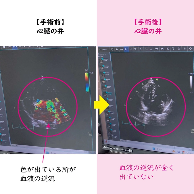術後の1ケ月検診に行ってきました！