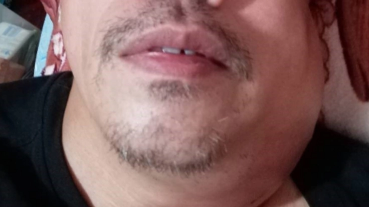 首のしこりを取る手術代を支援してください