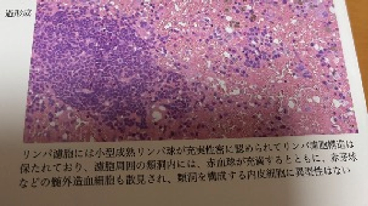 本日抜糸をしました。