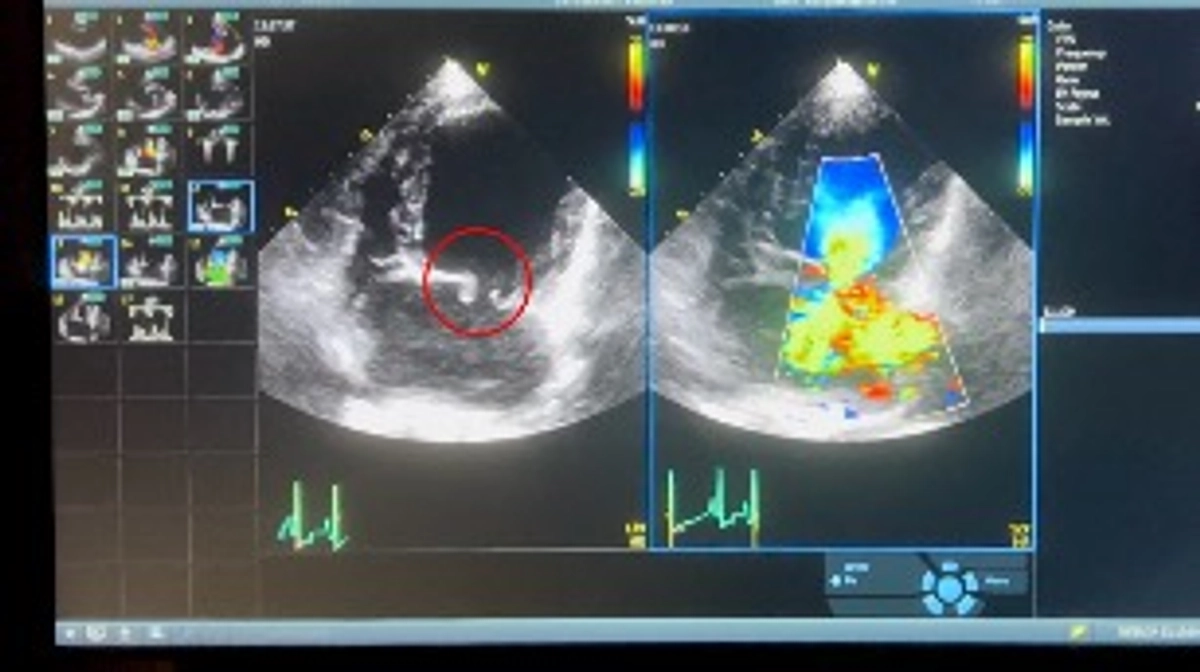 検査結果① “弁”について