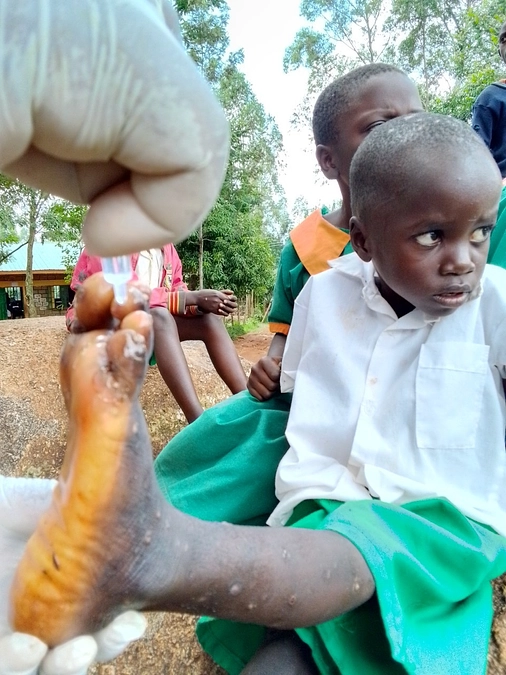 【6月21日】小学校での治療キャンペーンを実施(※閲覧注意画像含みます)