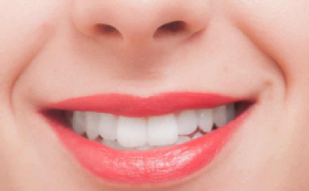 【お試し】ホワイトニング1回無料券