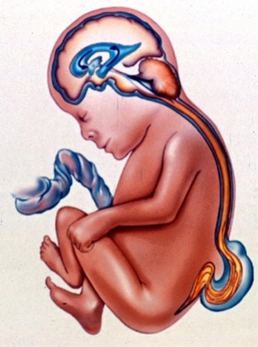 【情報①】胎児手術の対象となるのは、脊髄髄膜瘤・脊髄披裂です。