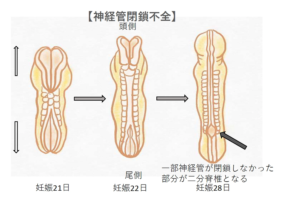 【情報②】なぜ胎児手術なの？