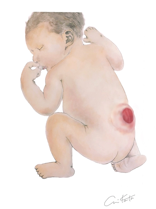 【情報④】脊髄髄膜瘤胎児手術の効果とリスク