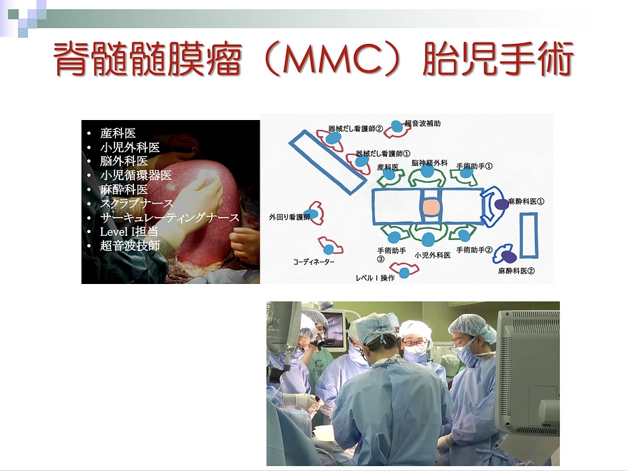 【情報③】脊髄髄膜瘤に対する胎児手術とは？