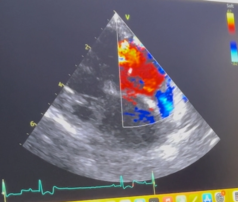 アポの病気（三尖弁閉鎖不全症）