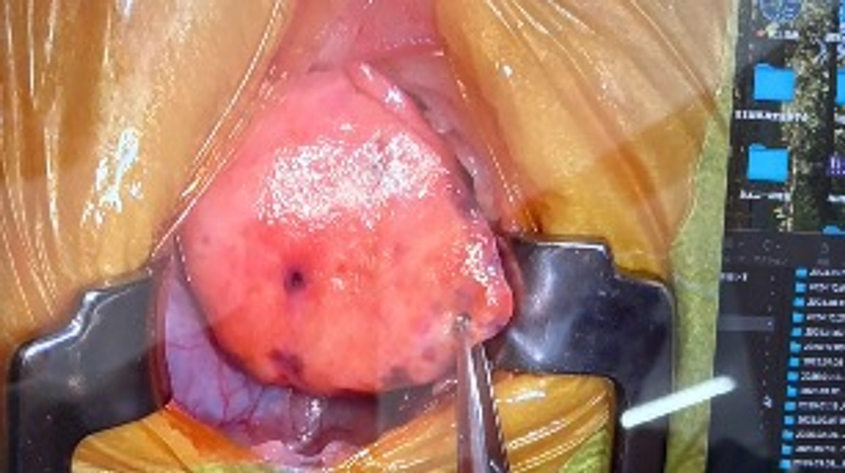 肺の腫瘍の検査結果