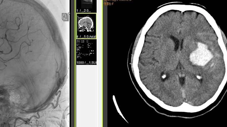 "三途土産"との闘い(脳出血後遺症の介護とリハビリ)の記録の出版