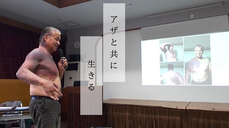 癌とリンパ腫の今、生きているうちに赤アザの足跡を残したい。