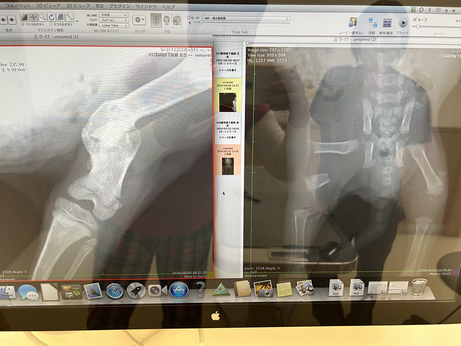 ５月に保護した赤ちゃんたち　成長後のレントゲンで先生もビックリ❣️