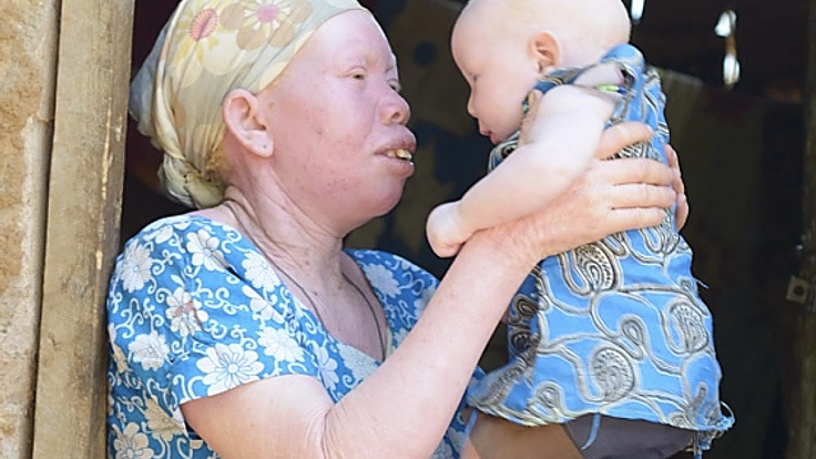 タンザニアのアルビノを徹底的に調査し、彼らを助けたい！