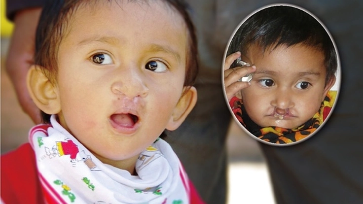 ネパールの子どもたちを笑顔に！差別と障害で苦しむ患者さんのために医療チームを派遣！