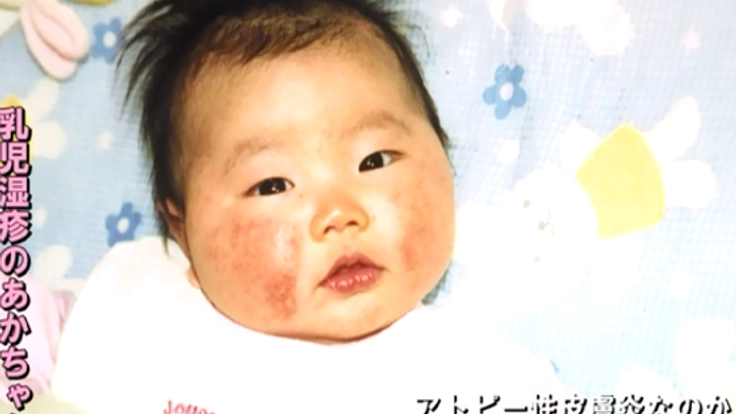 肌トラブル・アトピー子育て支援番組DVDを全国に残したい!
