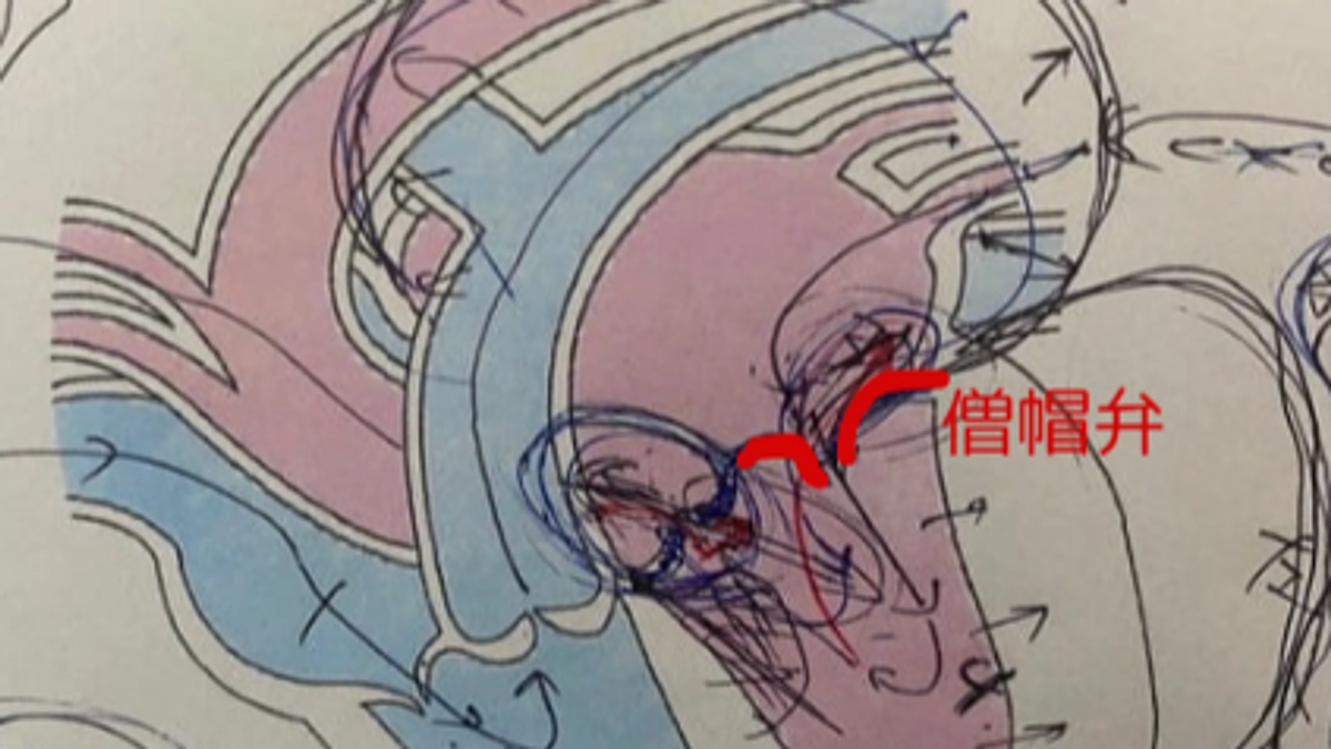 【残り９日】僧帽弁閉鎖不全症と僧帽弁異形成疑いについて