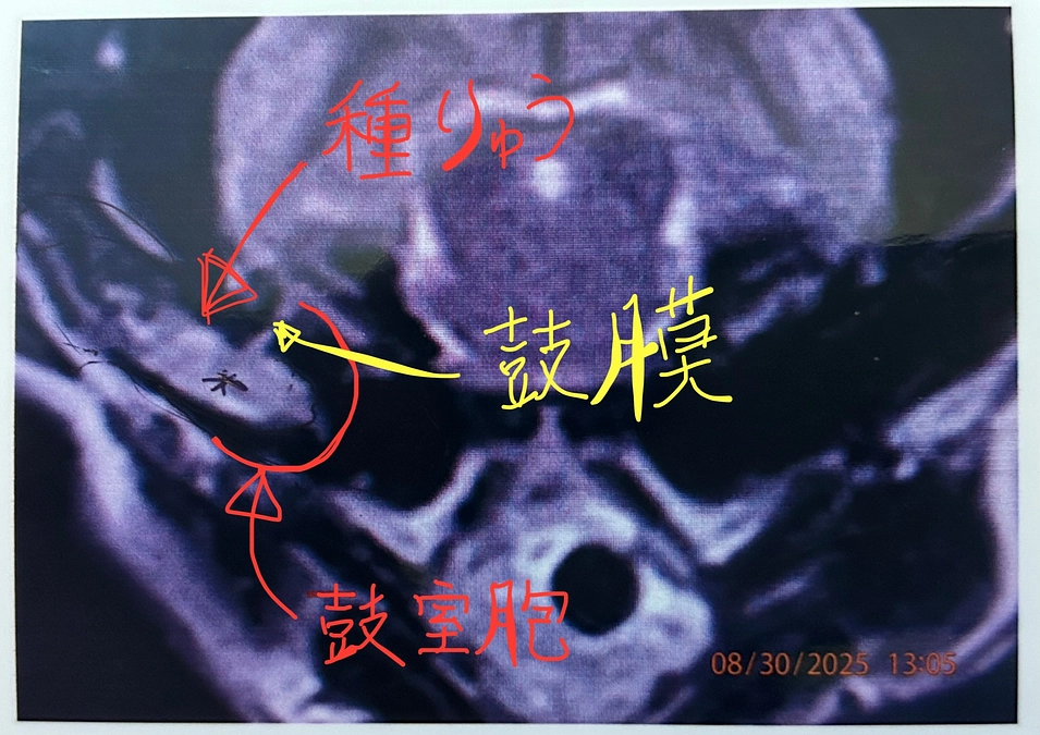 ＭＲＩ検査結果のご報告。