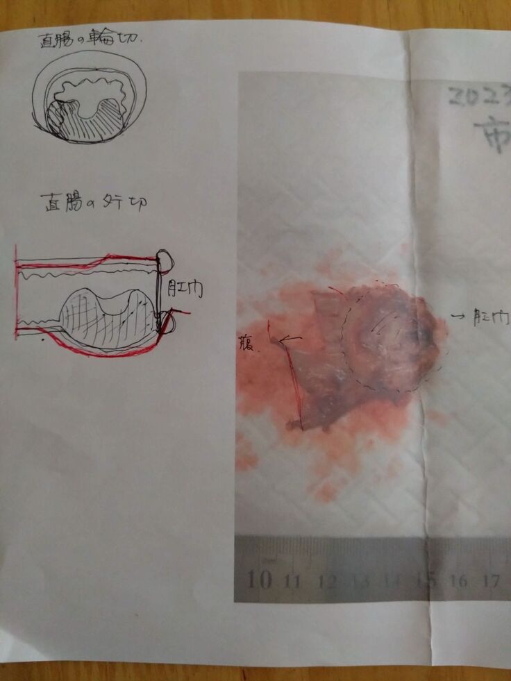 直腸腫瘍の摘出手術