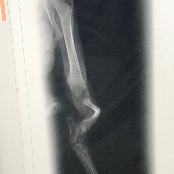脚のレントゲン
