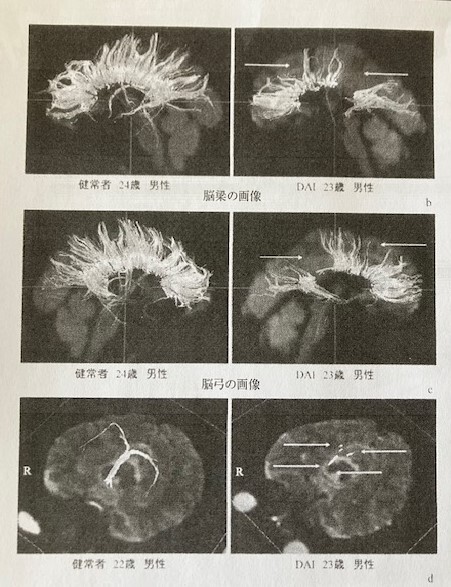 ファイバークロマトグラフィーによる脳梁画像（右健常者　左患者）