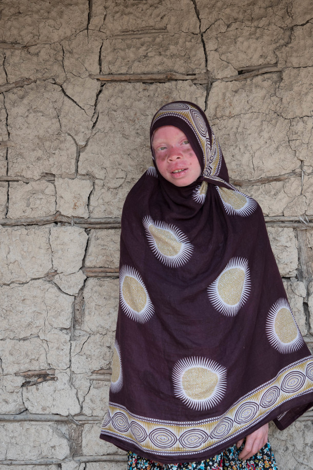 アルビノ少女、リンディ