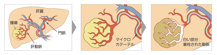 血管内治療イメージ