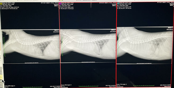 右から入院直後、抗がん剤１回目、２回目