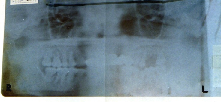 レントゲンフィルム写真（RL）