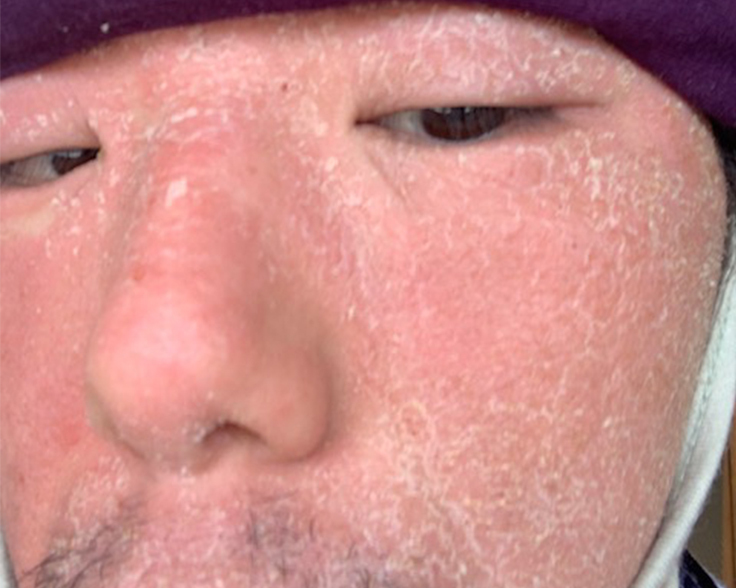 化学物質過敏症の症状