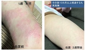 アトピー性皮膚炎の皮膚の改善