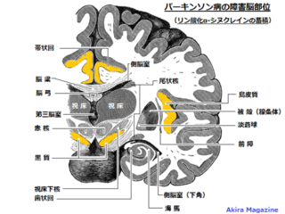 人工知能を使い パーキンソン病に悩む人達を助けたい。 のトップ画像
