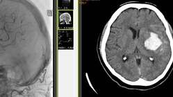 "三途土産"との闘い(脳出血後遺症の介護とリハビリ)の記録の出版 のトップ画像