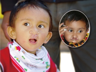 ネパールの子どもたちを笑顔に！差別と障害で苦しむ患者さんのために医療チームを派遣！ のトップ画像