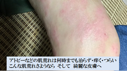 アトピーさようなら！肌荒れを保護して綺麗な皮膚にするパッチ開発 のトップ画像